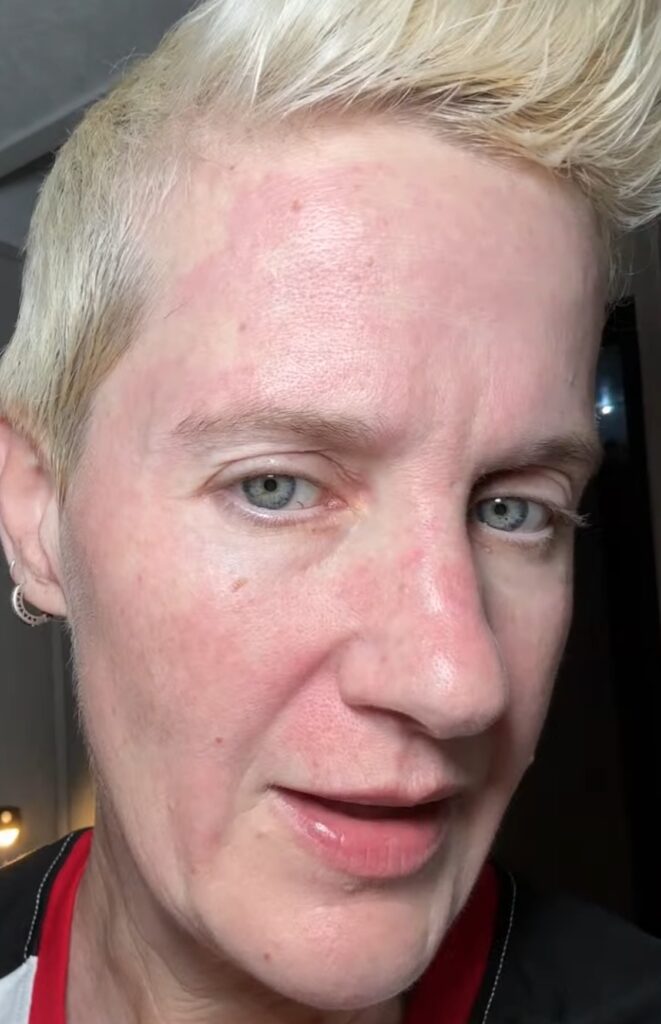 Dermatitis and Rosacea outbreak