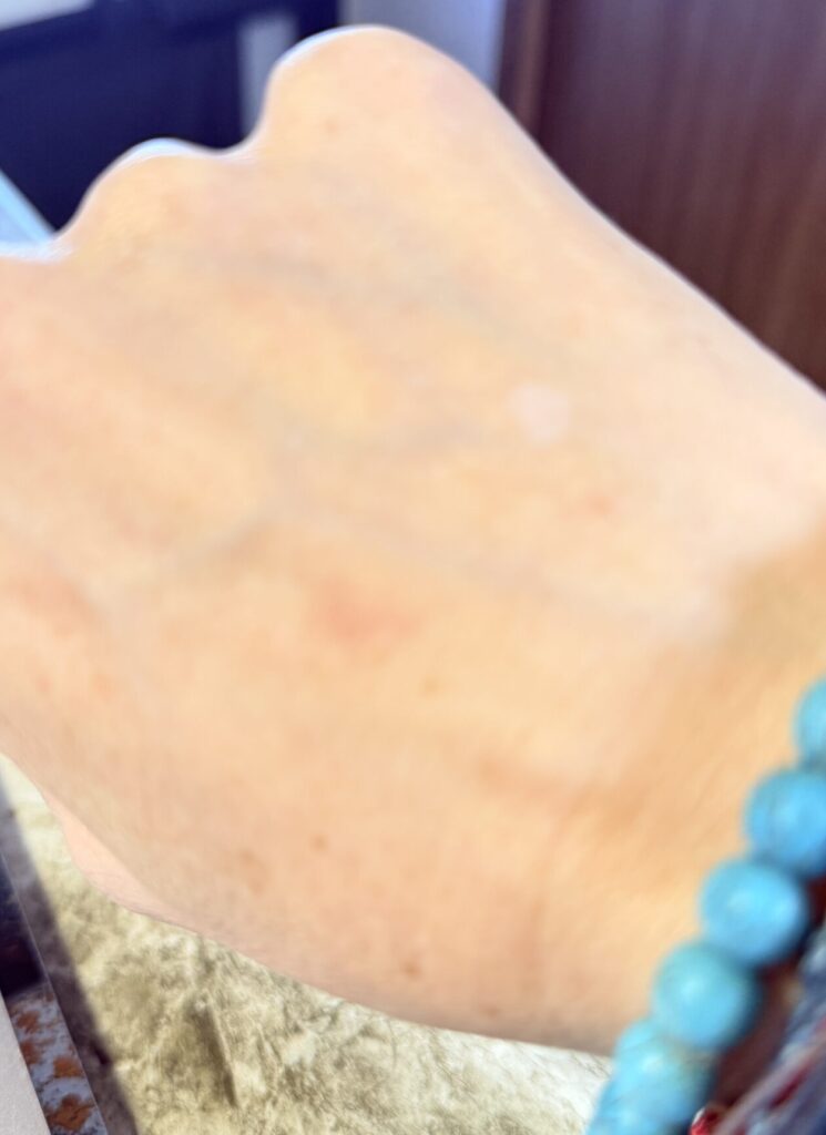 Vitiligo spot on my right hand.