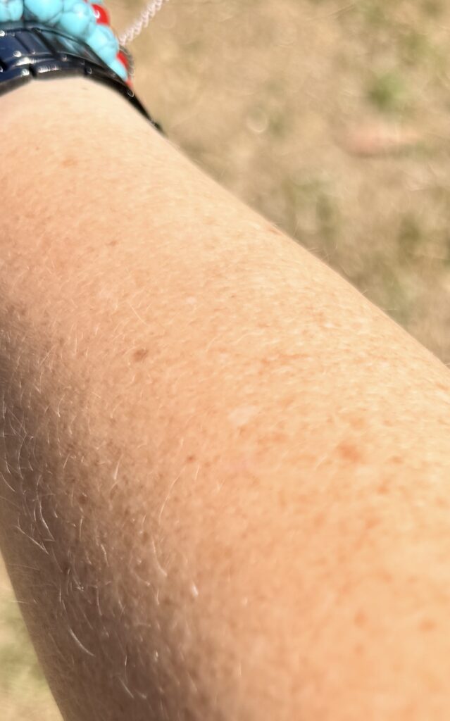 Vitiligo spots around my body. These are just a few that stand out