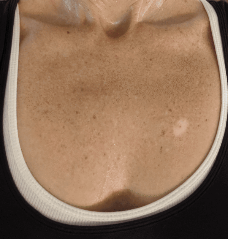 Vitiligo and Gut Health | The Connection I Didn't See Coming